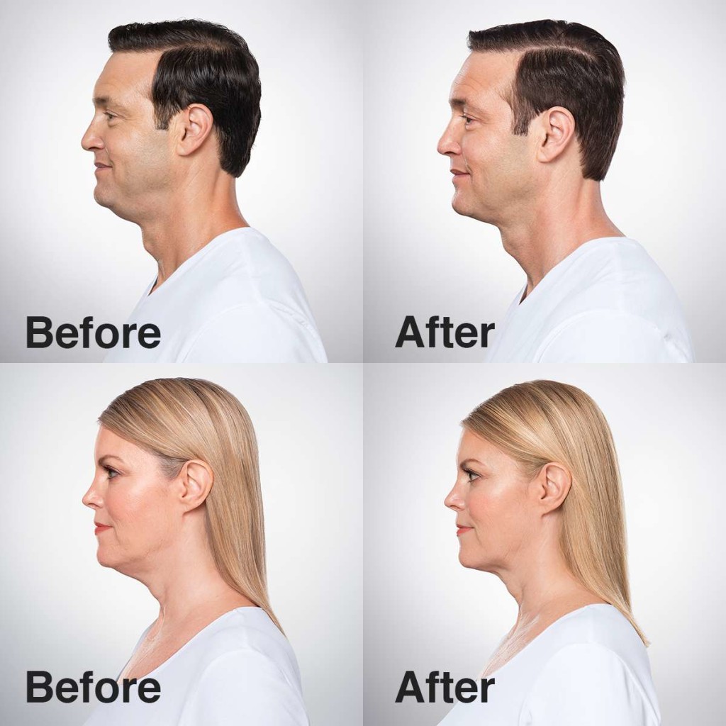 Kybella® For Treatment Of Double Chins Salmon Creek Plastic Surgery