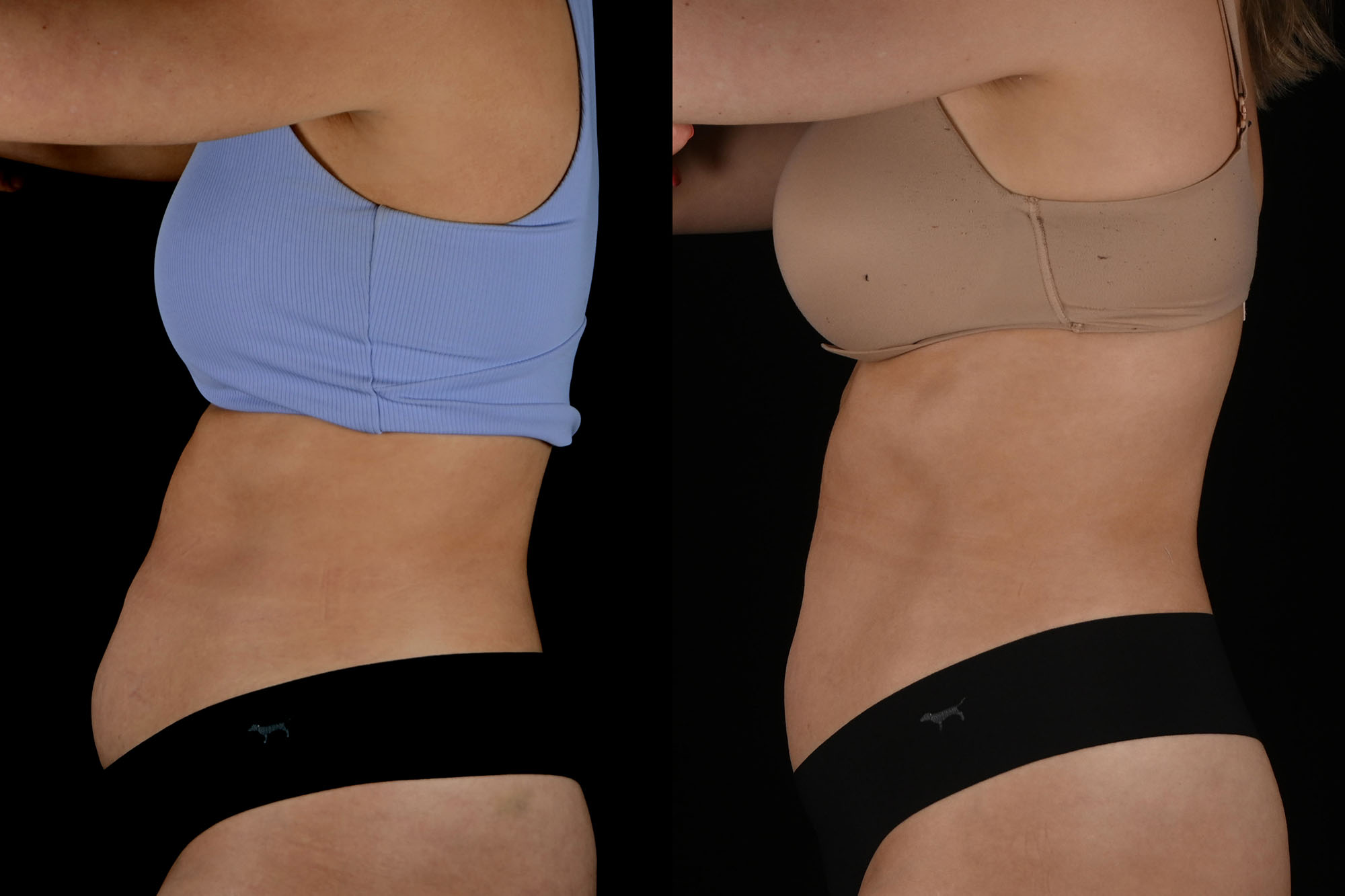 Before and After photo of left side of women showing smaller stomach after truBody treatments.