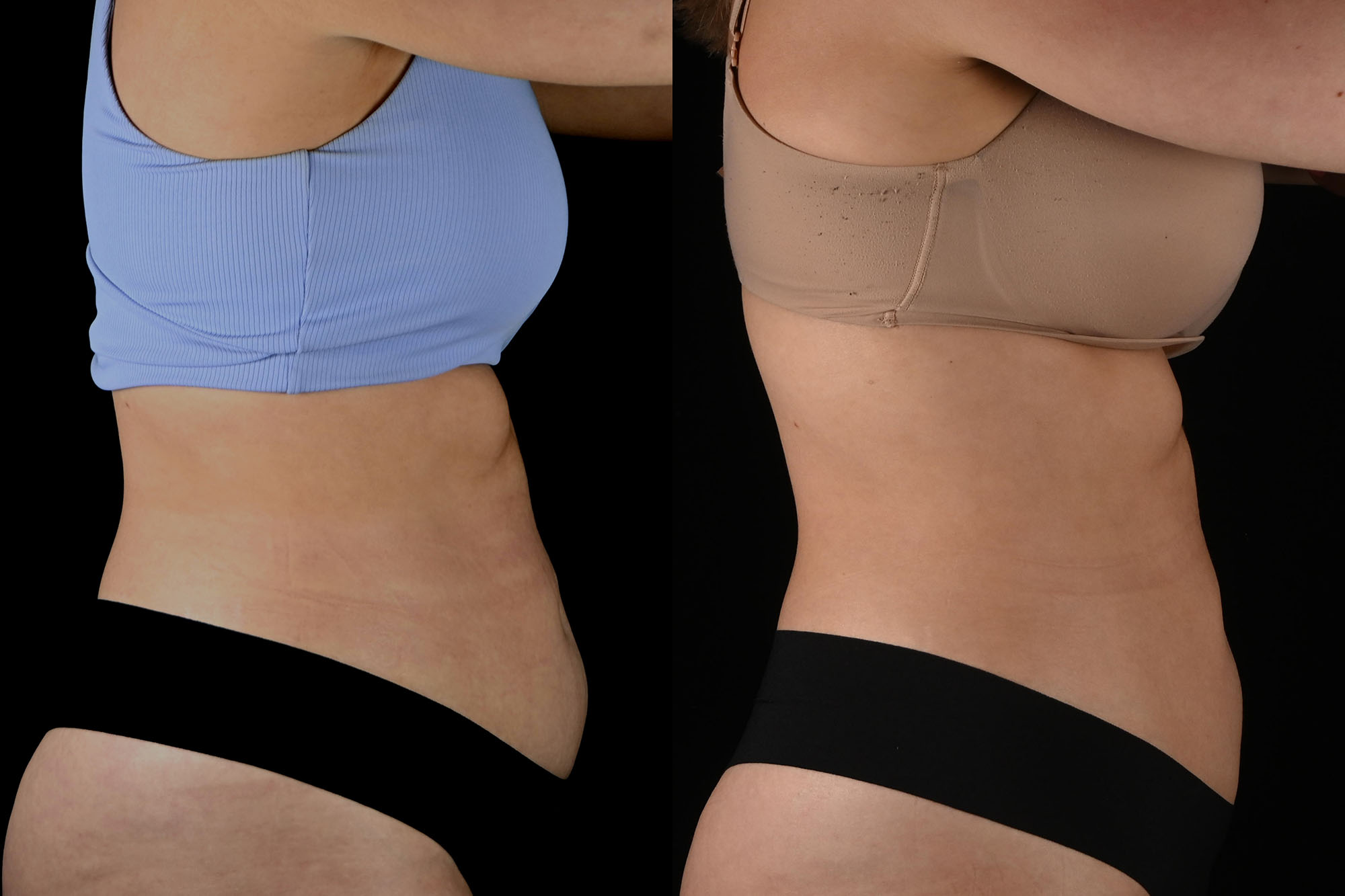 Before and After photo of right side of women showing smaller stomach after truBody treatments.