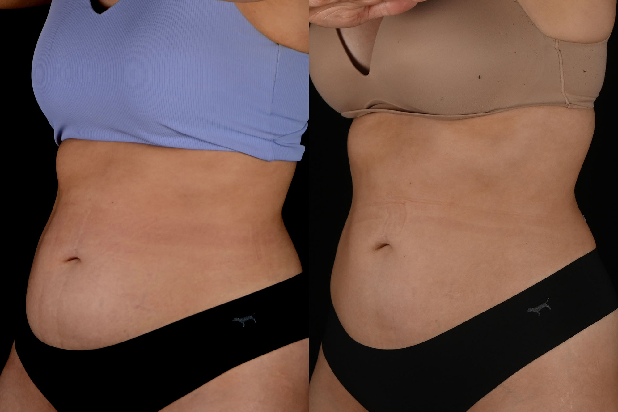 Before and After photo of 3/4 view of women showing smaller stomach after truBody treatments.